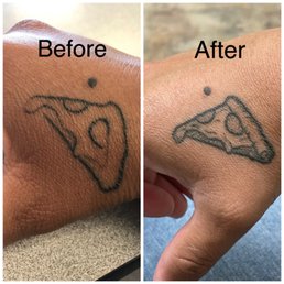 Austin fixed the original tattoo (left) by another artist. The improved and healed work is on the right. Austin fixed the original tattoo (left) by another artist. The improved and healed work is on the right.