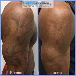 Enlighten Aesthetic of Cleveland - Enlighten Laser Tattoo Removal works extremely well on darker skin tones - this is after only 1 session.