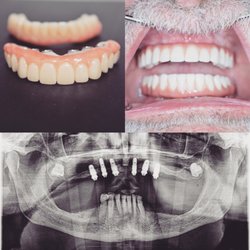 LG Elite Dental & Orthodontics - All-On-Six(six implants supported full zirconia restoration)