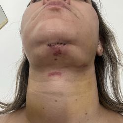 Healing and sores from wrap