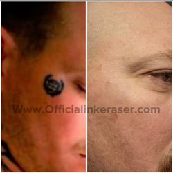 The INK Eraser - Face tattoo removal after 10 sessions 
This was a new dark/dense tattoo and required many sessions to fully remove.