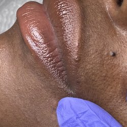 Gorgeouz Facez Spa - A large blackhead on top lining of lip