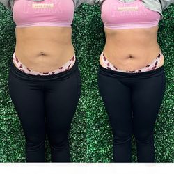 Shape Of You Beauty Bar - Reducing the waist in just 1 session
