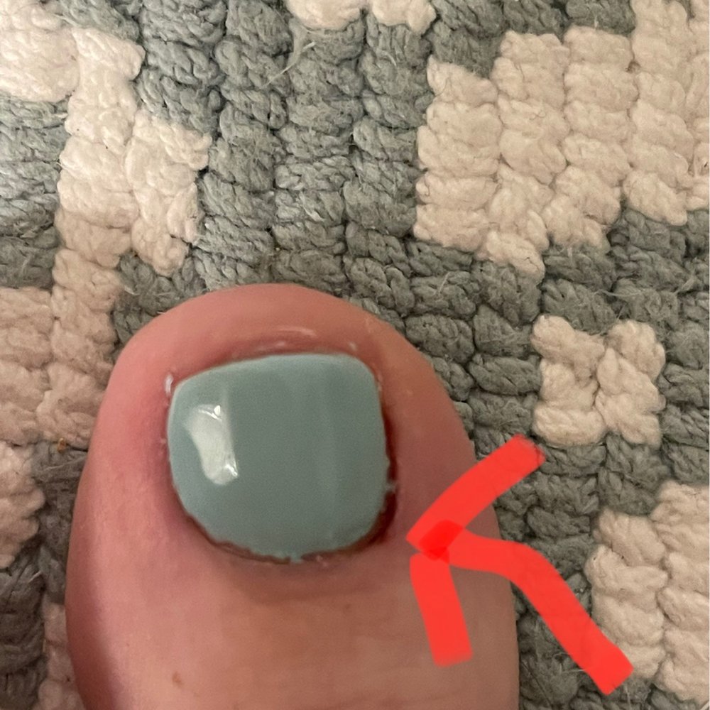Cuticles cut too much. Cuticles cut too much.
