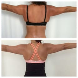 New Heights Medspa - 4 sessions in 3 weeks, 20 years off the arms.