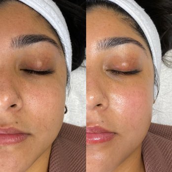 Cynesthetics - dermaplane facial. before (left) & after (right). instantly softer skin that is visibly smoother! recommended every 4 weeks. - Eyelash Service Near Me