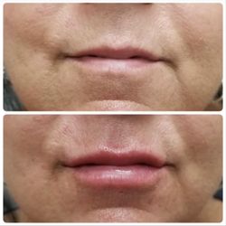 Deja Vu Med Spa & Salon - Lip Filler Juvederm