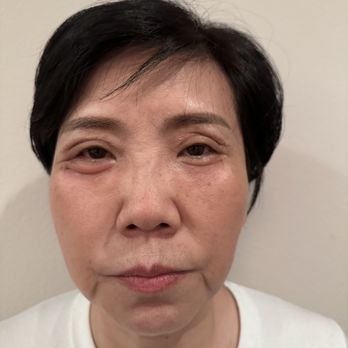 Lawton W Tang, MD - 26 days after the operation, my mother's eyes had obvious large and small eyes, the two eyes were asymmetrical, and there were deep eye sock - Cosmetic Surgeons Near Me - Pasadena, California Lawton W Tang, MD - 26 days after the operation, my mother's eyes had obvious large and small eyes, the two eyes were asymmetrical, and there were deep eye sock - Cosmetic Surgeons Near Me - Pasadena, California