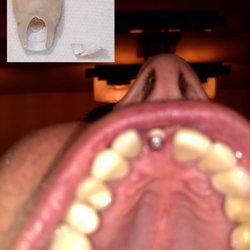 Paradise Ridge Family Dentistry - Dr. Kloss #8 crown repeatedly breaks off implant because abutment is improper and Desert Ridge Dentistry NOT REFUNDING!!