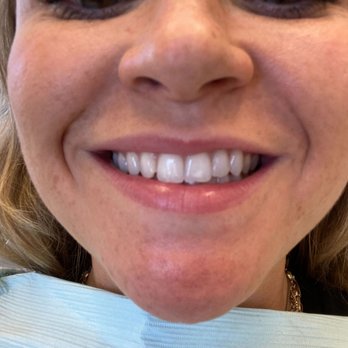 Post Family Dental - BEFORE: chip & discoloration on front tooth - Cosmetic Dentists Near Me - Chicago, Illinois