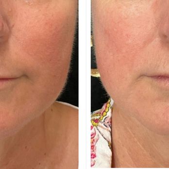 Rejuvenate 528 - Real patient results achieved through a personalized treatment plan designed around individual skin goals. - Medical Spas Near Me - Sarasota, Florida Rejuvenate 528 - Real patient results achieved through a personalized treatment plan designed around individual skin goals. - Medical Spas Near Me - Sarasota, Florida
