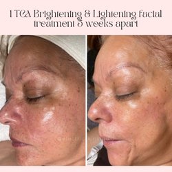 Electric Skin Studio - Brightening skin treatments to help improve skin tone and clarity