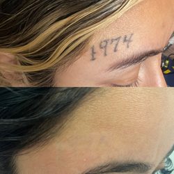 Allure laser Tattoo Removal