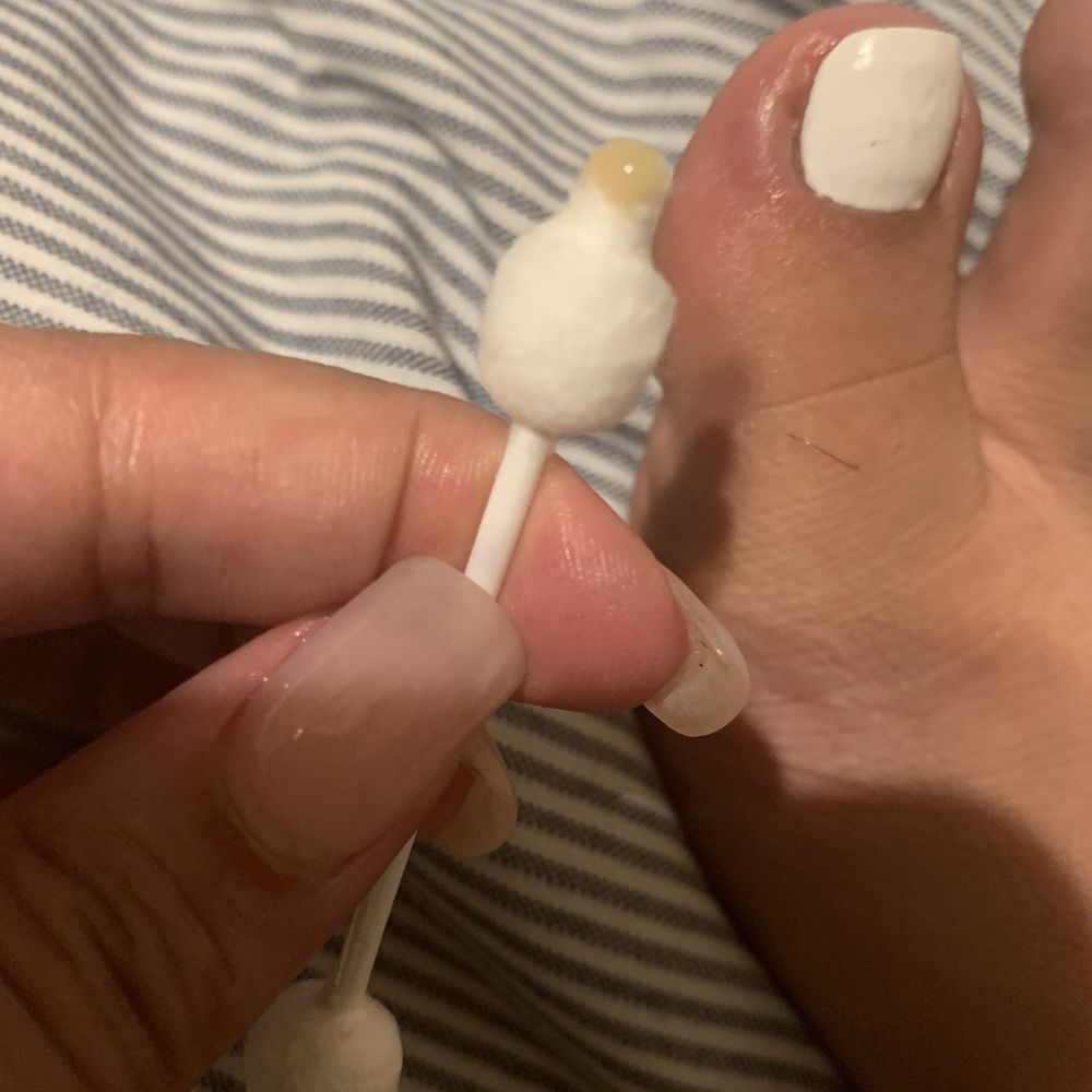Lashes N Nails - **GRAPHIC PHOTO** this is the infection 3 days after my pedicure - Nail Salons Near Me - Tempe, Arizona Lashes N Nails - **GRAPHIC PHOTO** this is the infection 3 days after my pedicure - Nail Salons Near Me - Tempe, Arizona
