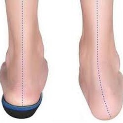 Teitelbaum Pedorthist - Flat feet, Pes Planus