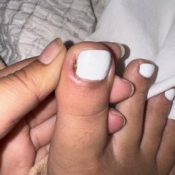 SF Nail Spa - Infection from where nail tech poked me - Nail Salons Near Me - San Francisco, California SF Nail Spa - Infection from where nail tech poked me - Nail Salons Near Me - San Francisco, California
