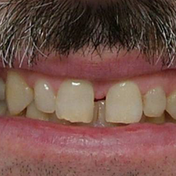 Gillum Dentistry - Before six month smiles @ Gillum Dentistry
