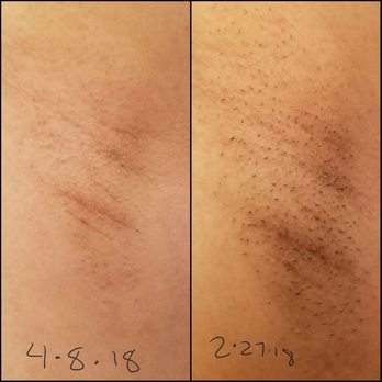 Ideal Image The Woodlands - You can definitely see results just started second treatment yesterday 4-7-18 in love way lighter then it was. - Laser Hair Removal Near Me - Shenandoah, Texas Ideal Image The Woodlands - You can definitely see results just started second treatment yesterday 4-7-18 in love way lighter then it was. - Laser Hair Removal Near Me - Shenandoah, Texas