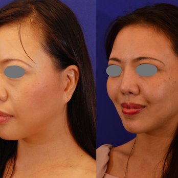 Behrooz Torkian Facial Plastic Surgery - Revision rhinoplasty with repositioniong / revision of chin implant - Cosmetic Surgeons Near Me - Beverly Hills, California