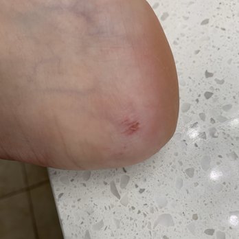 Serenity Nails and Day Spa - Damaged heel--this was not a previous blister. My heel was scrubbed too hard - Day Spas Near Me - Frisco, Texas