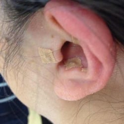 Yang's Acupuncture and Herbs - Auricular therapy