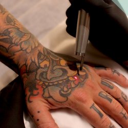 The Tattoo Removal Co - The Tattoo Removal Co - Laser Tattoo Removal and Fading Adelaide