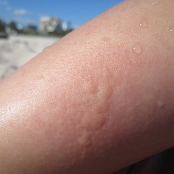 Lummus Park on South Beach - Portuguese Man O'War sting! It started to bubble! - Parks Near Me - Miami Beach, Florida Lummus Park on South Beach - Portuguese Man O'War sting! It started to bubble! - Parks Near Me - Miami Beach, Florida