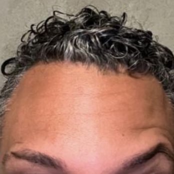 Wellness Med Art - Forehead lines still visible, one brow dropped, one raised and frozen this way. - Medical Spas Near Me - Forest Hills, New York Wellness Med Art - Forehead lines still visible, one brow dropped, one raised and frozen this way. - Medical Spas Near Me - Forest Hills, New York