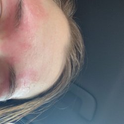 Hollywood Hair - Blisters from hot wax!!