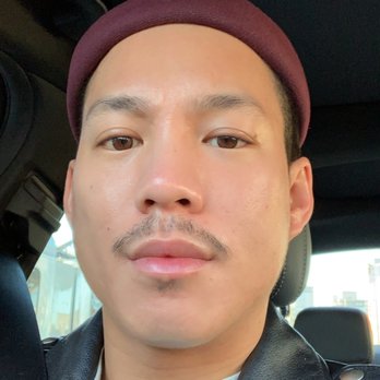 Asandra MD - My skin after the treatment :) - Medical Spas Near Me - Beverly Hills, California Asandra MD - My skin after the treatment :) - Medical Spas Near Me - Beverly Hills, California