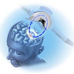 TMS Center of Chappaqua New York - Transcranial Magnetic Stimulation