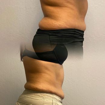 Newday Beauty and Wellness - Body Contouring Near Me - Franklin Square, New York Newday Beauty and Wellness - Body Contouring Near Me - Franklin Square, New York