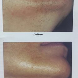 New Image Laser - 3-5 treatment and you will be hairless.