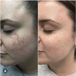 Bellevue Laser and Cosmetic Center - Before and after!