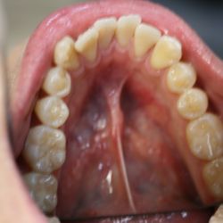 Alex Jhang, DDS - Before Invisalign
