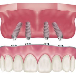 Oasis Dental - All on 4--  Dental implants done at our office by our Surgical & restorative team.