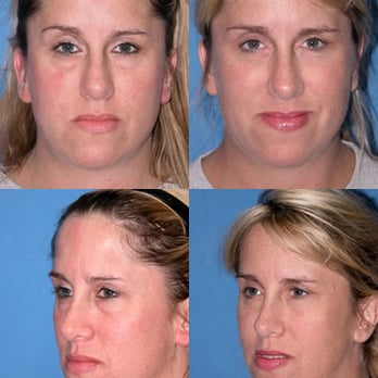 Image by Design Plastic Surgery - Blepharoplasty - Eyelid Surgery before and after photo - Plastic Surgeons Near Me - St Clair Shores, Michigan Image by Design Plastic Surgery - Blepharoplasty - Eyelid Surgery before and after photo - Plastic Surgeons Near Me - St Clair Shores, Michigan