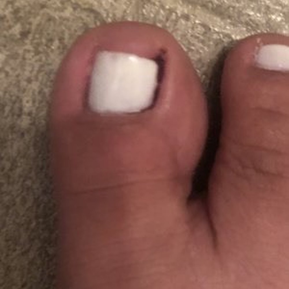 How my toes looked they hurted so bad