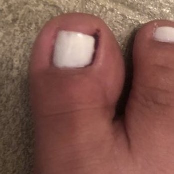 Famous Nails - How my toes looked they hurted so bad - The image depicts a close-up of a person's big toe with a white toenail. There is a small cut or injury visible near the base of the toenail, suggesting discomfort or pain. The background appears to be a textured surface, possibly a carpet or fabric. - Nail Salons Near Me - Albuquerque, New Mexico