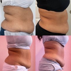 Snatched Cavitation - Two rounds of 12 sessions.