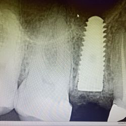 Dental House of Ann Arbor - Dental implant