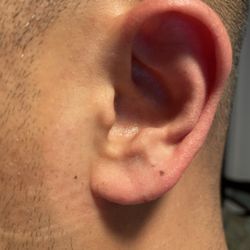 Michael Yong - Picture of my left ear where my infection was