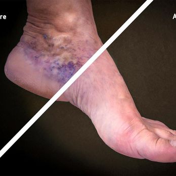 USA Vein Clinics - Before and after vein treatment - Vascular Medicine Near Me - Decatur, Georgia USA Vein Clinics - Before and after vein treatment - Vascular Medicine Near Me - Decatur, Georgia
