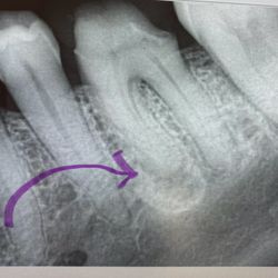 Torrance Endodontix - BEFORE: infected root was causing pain up my jaw and into my head!