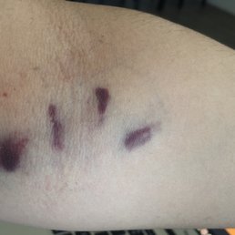 Day after Hematoma