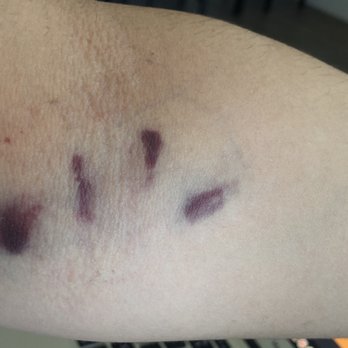 Labcorp - Day after Hematoma - Laboratory Testing Near Me - Mountain View, California