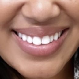Before braces Before braces