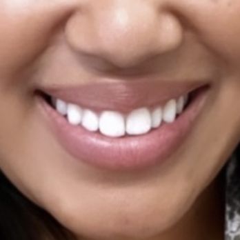 Advanced Family Dentistry - Before braces - Cosmetic Dentists Near Me - Rancho Cucamonga, California Advanced Family Dentistry - Before braces - Cosmetic Dentists Near Me - Rancho Cucamonga, California
