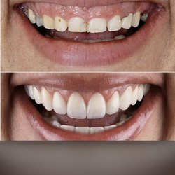 Samira Seini, DDS - Gum lift and beautiful veneers