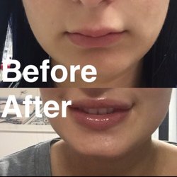 Rejuvenation Skin & Laser Center - Richelle fixed a bad lip augmentation I had done almost a year ago that was still haunting me!